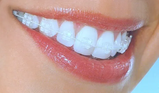Sorriso com aparelho ortodôntico