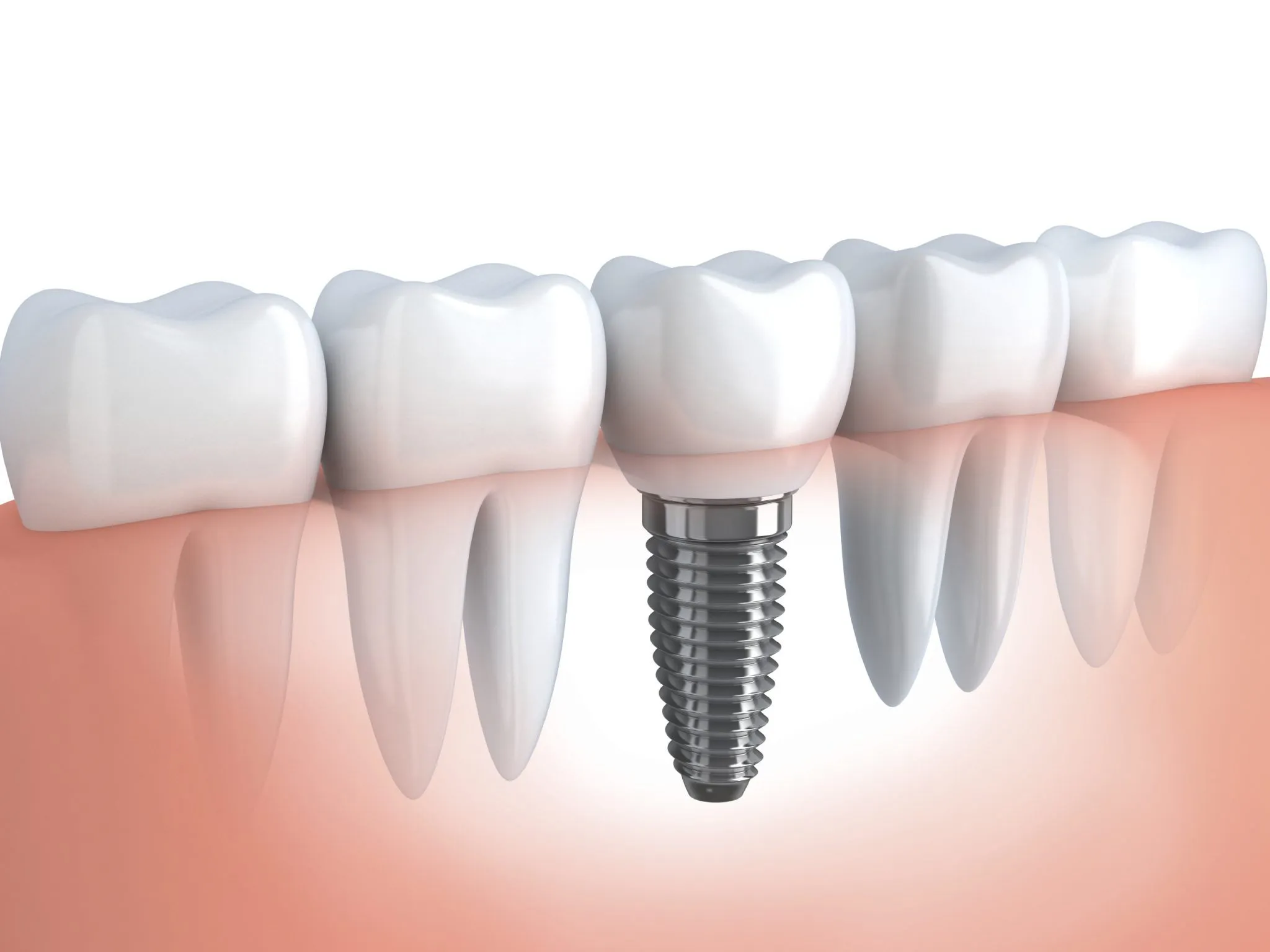 Implante Dentário: O Guia Absolutamente Completo