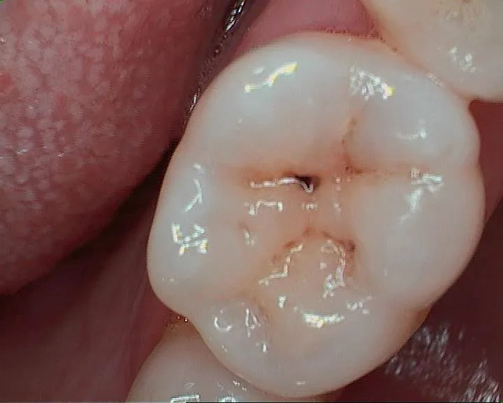 A destruição química visível da cárie sob o esmalte