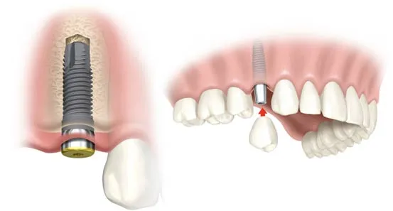 Pilar do Implante Dentário