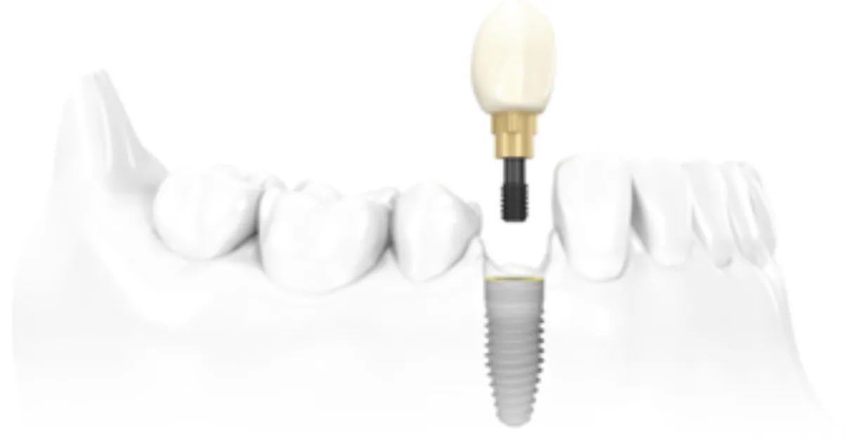 Implante dentário unitário