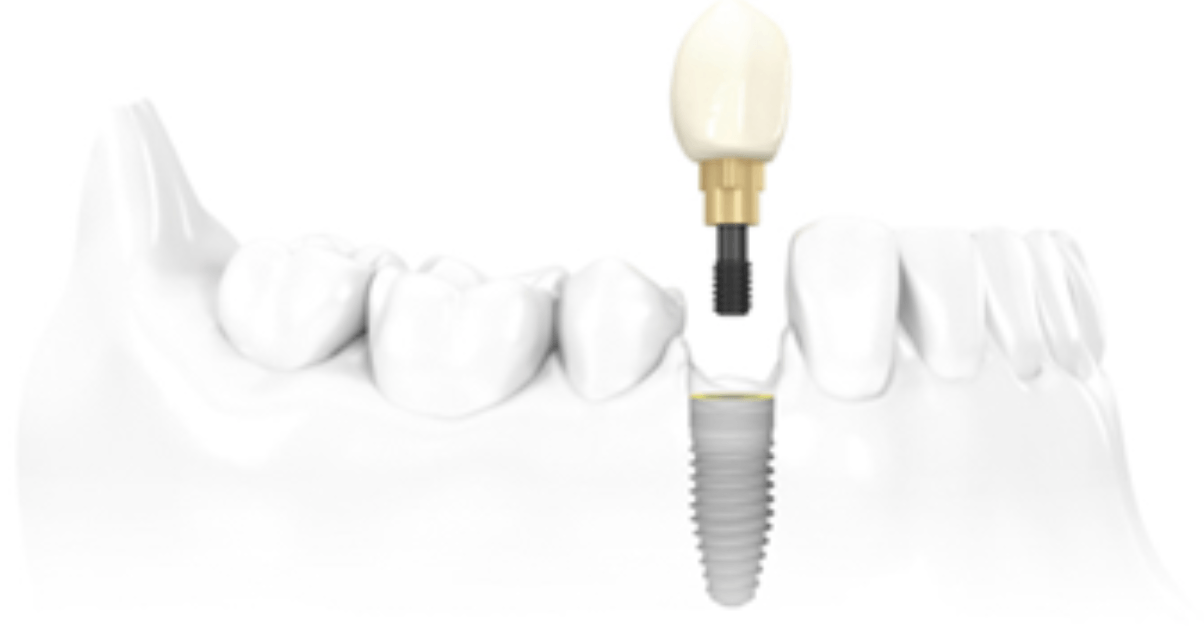 Implante Dentário - O Guia Absolutamente Completo | MD Odontologia