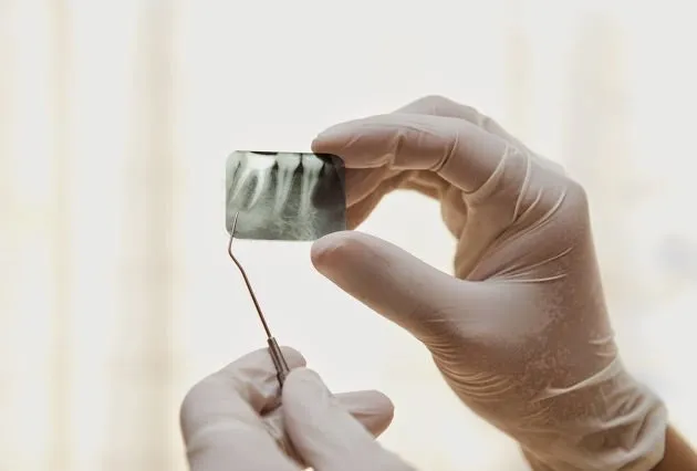 Tratamento de canal - Quando precisamos realizar esse procedimento ?!