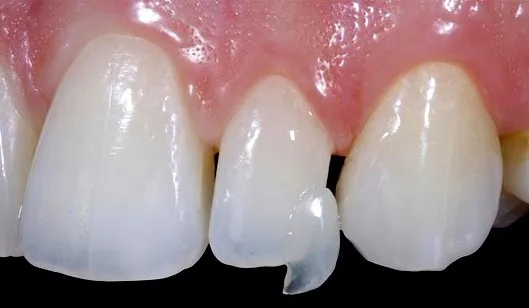 Lente de contato dental na ponta dos dedos