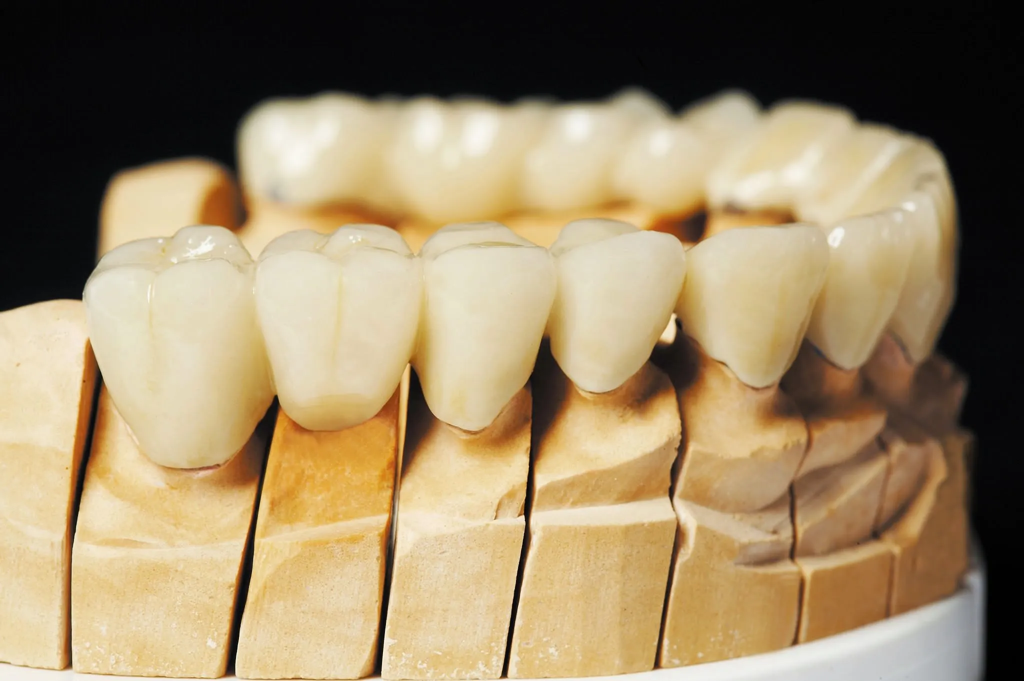 O que é uma prótese dentária fixa ?
