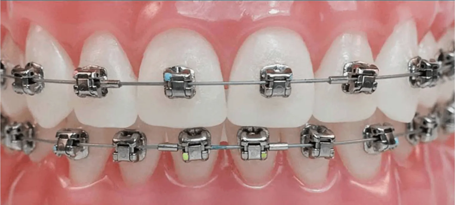 Aparelho Ortodôntico: 7 Dúvidas Comuns sobre Ortodontia
