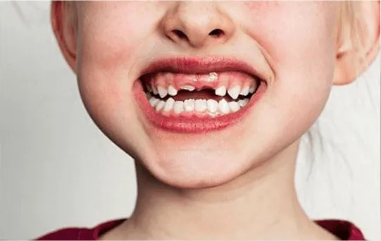 Crianças e os Dentes Quebrados - Como Tratar e evitar. 