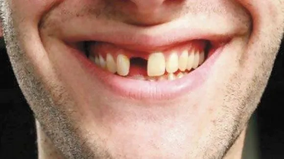 Perda de dentes e suas consequências.