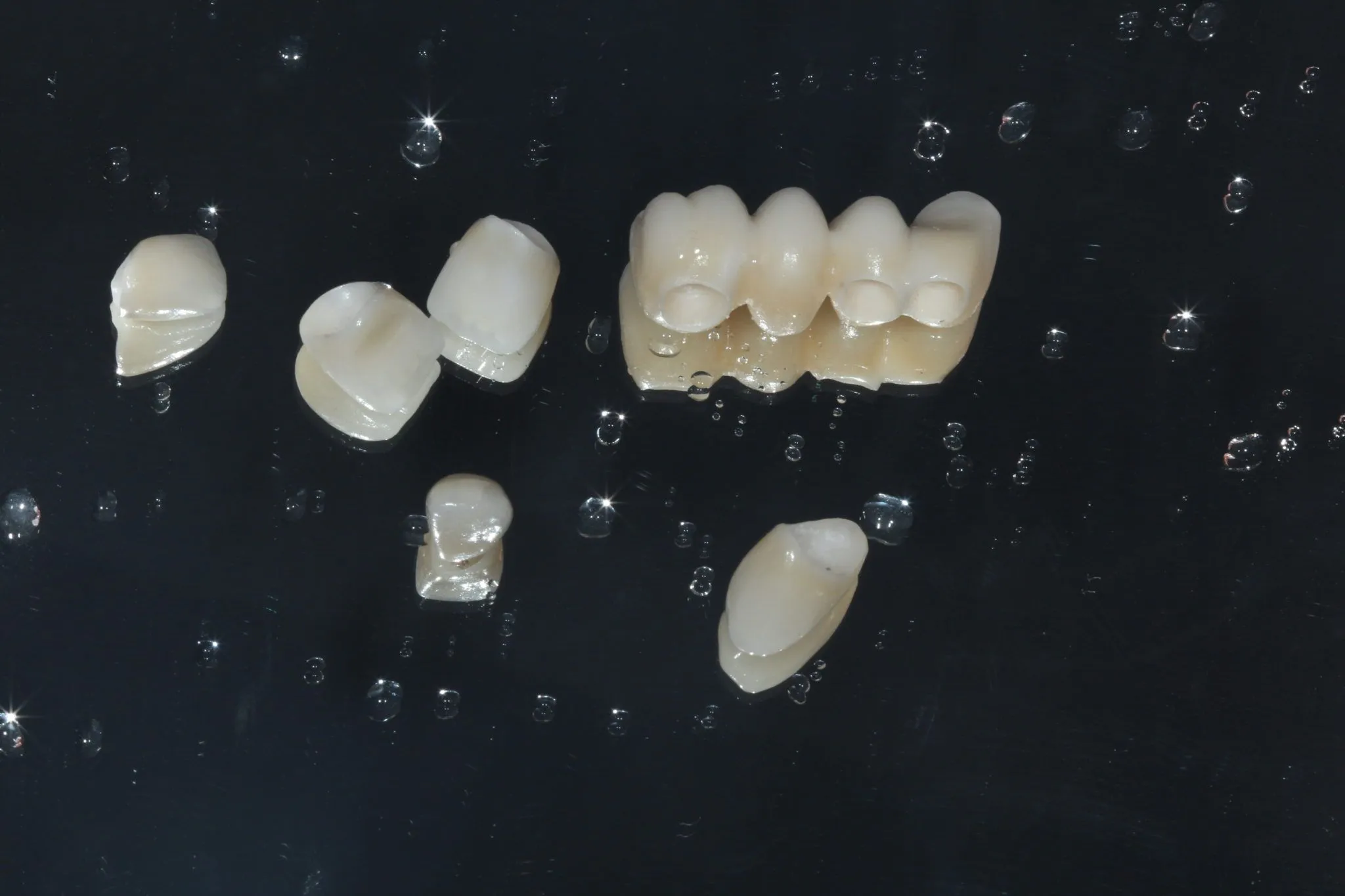 Dentes de Porcelana - A verdade sobre esse tipo de tratamento.