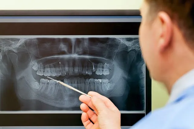 Perda Óssea Dentária - Veja as causas e como evitar.