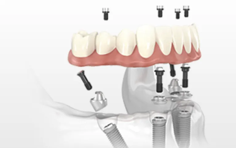 Implante dentário protocolo