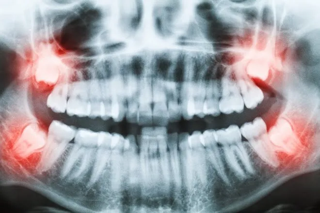 Demonstração animada da cirurgia de siso