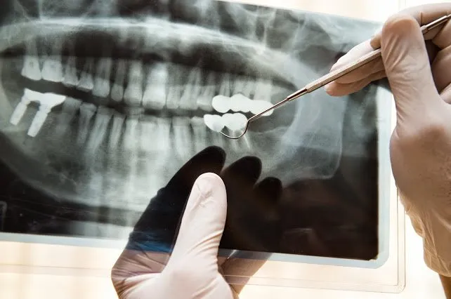 Reabilitação Oral: O que É e Como Recuperar o Sorriso