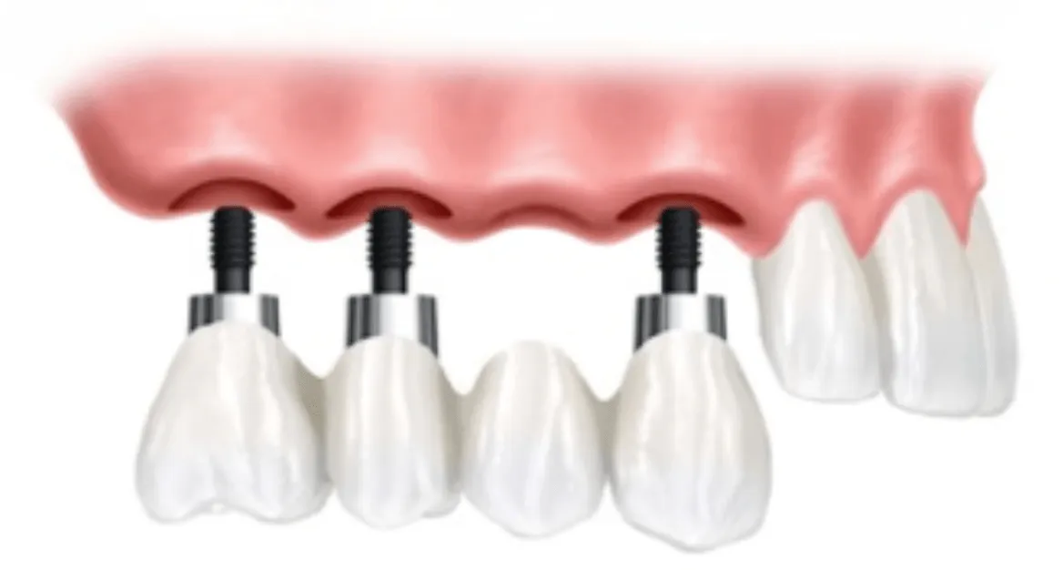 Implante dentário múltiplo