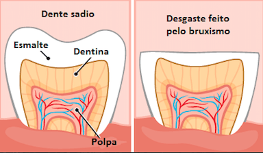 bruxismo causas