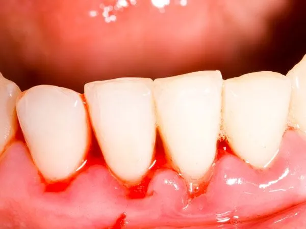 Gengiva Sangrando: 7 Causas e Tratamento Prático