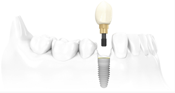 Implante dentário - Carga Imediata