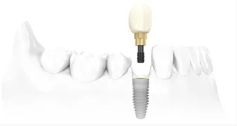 Perda de 1 dente : Prótese fixa X Implante . Qual o melhor ?