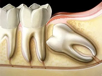 Por que extrair o siso ? Tire suas dúvidas sobre essa cirurgia.