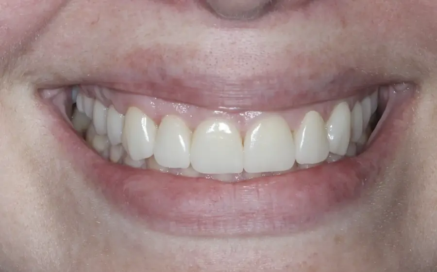 Facetas de Porcelana | Barra da Tijuca e Botafogo