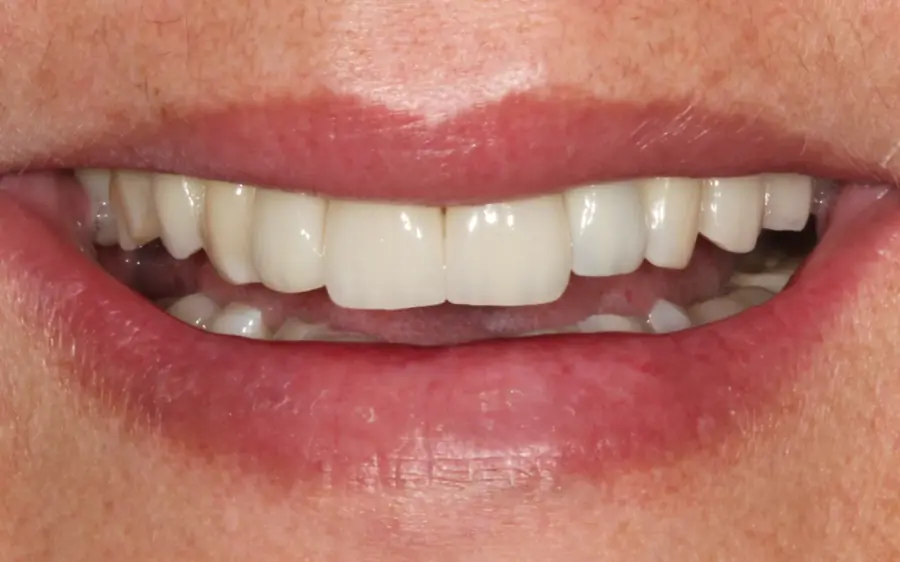 Lentes de Contato Dental | Barra da Tijuca e Botafogo