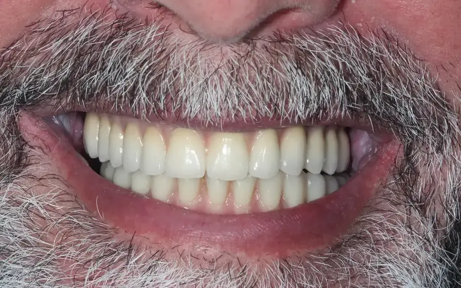 Clareamento Dental