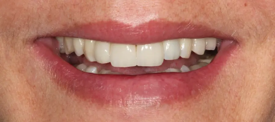 Clareamento Dental | Barra da Tijuca e Botafogo