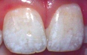 mancha nos dentes por fluorose