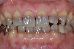 mancha nos dentes - tetraciclina