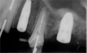 levantamento seio maxilar 1