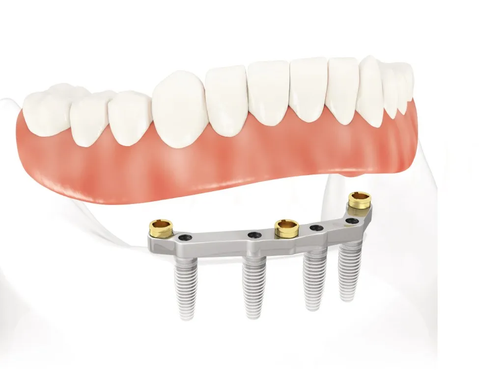 dentadura e implantes