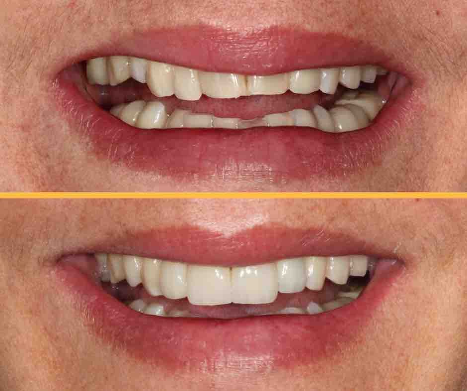 Transformação de Sorriso - Antes e Depois