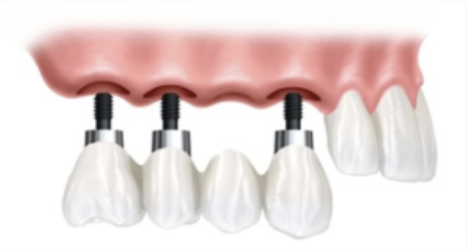 Implante Dentário Múltiplo