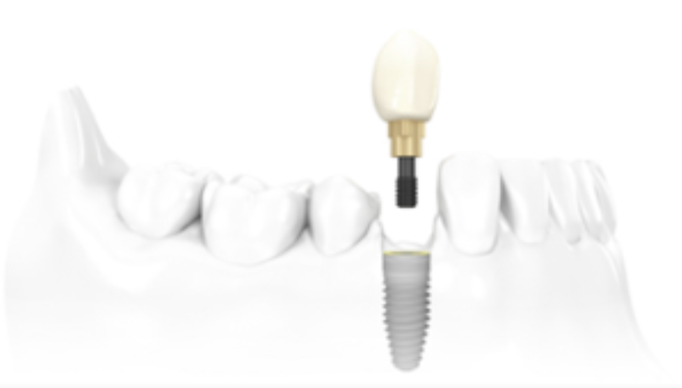 Implante Dentário Unitário