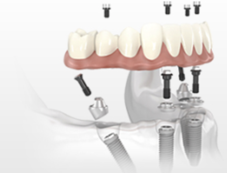 Implante dental - Protocolo