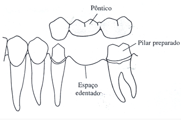 prótese dental